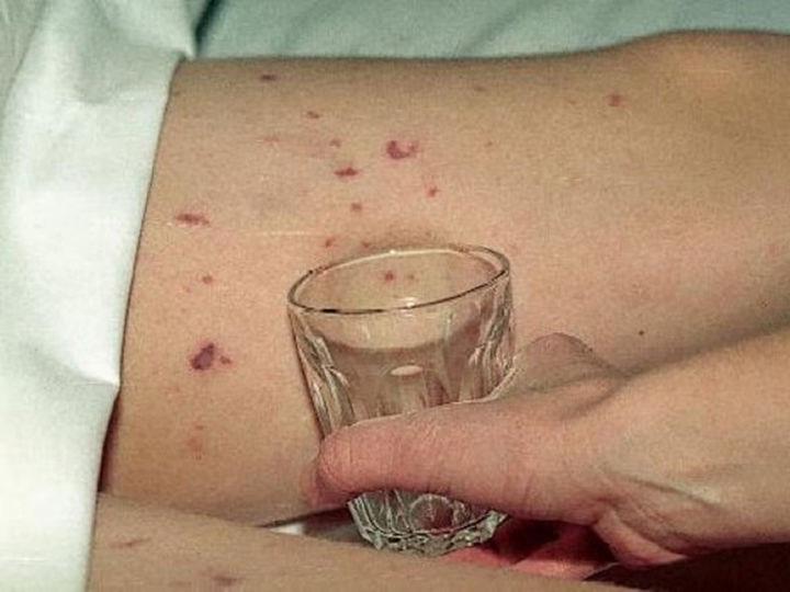 Illustrasjonsbilde meningokokkinfeksjon Foto: Folkehelseinstituttet Illustrasjonsbilde meningokokkinfeksjon