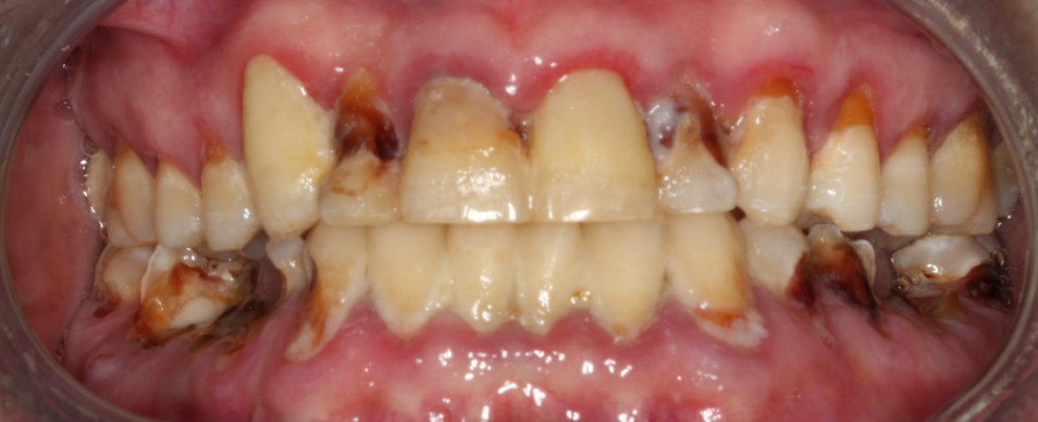 Recommended use of fluoride