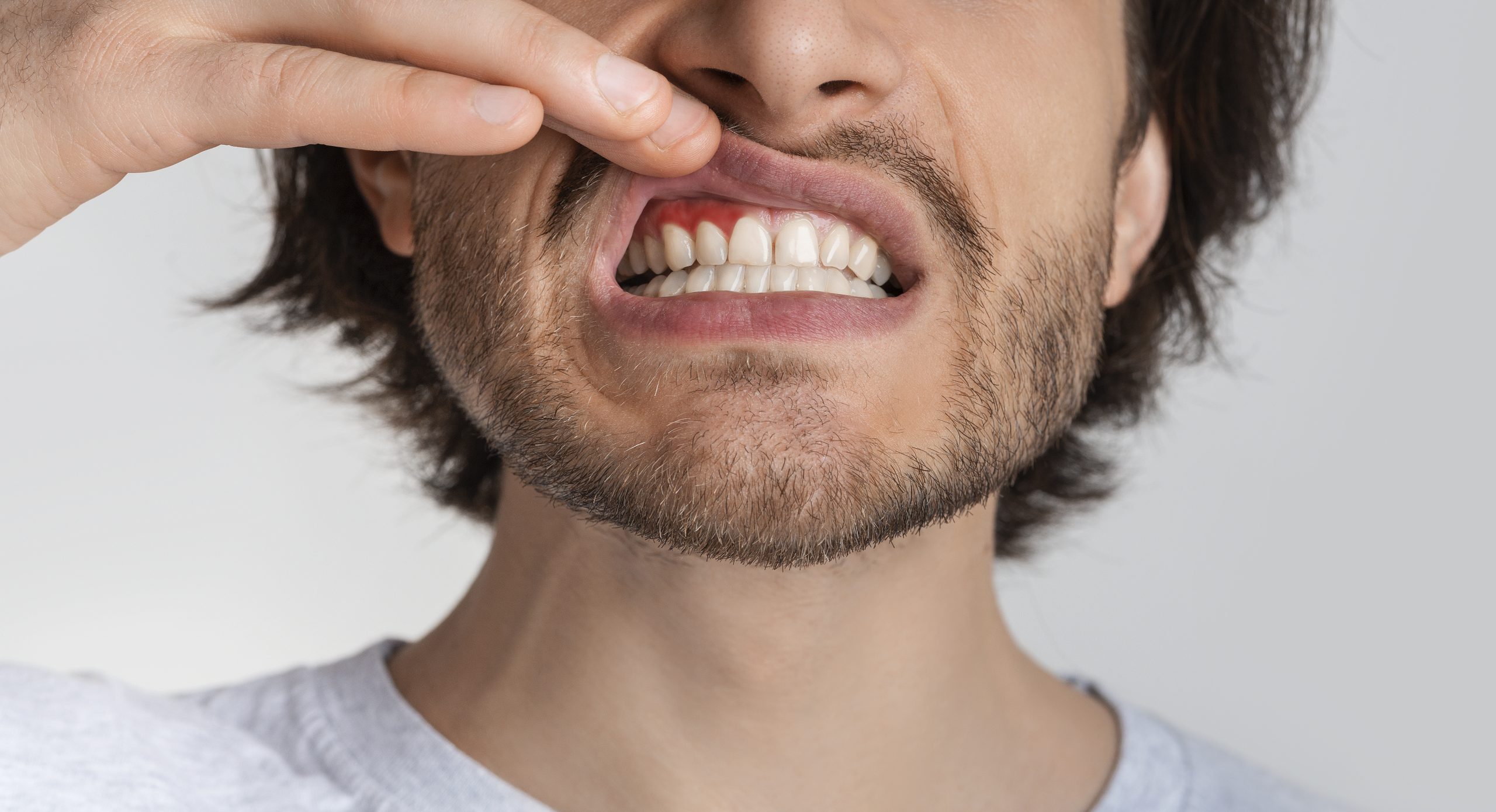Study show snus causes gingival retraction and lesions