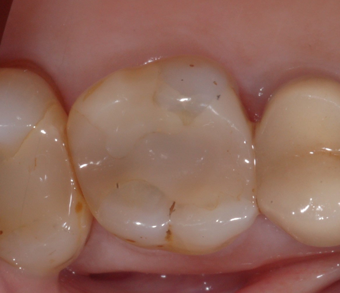 New “Universal bonding agents” reliable for repair of composite restorations.