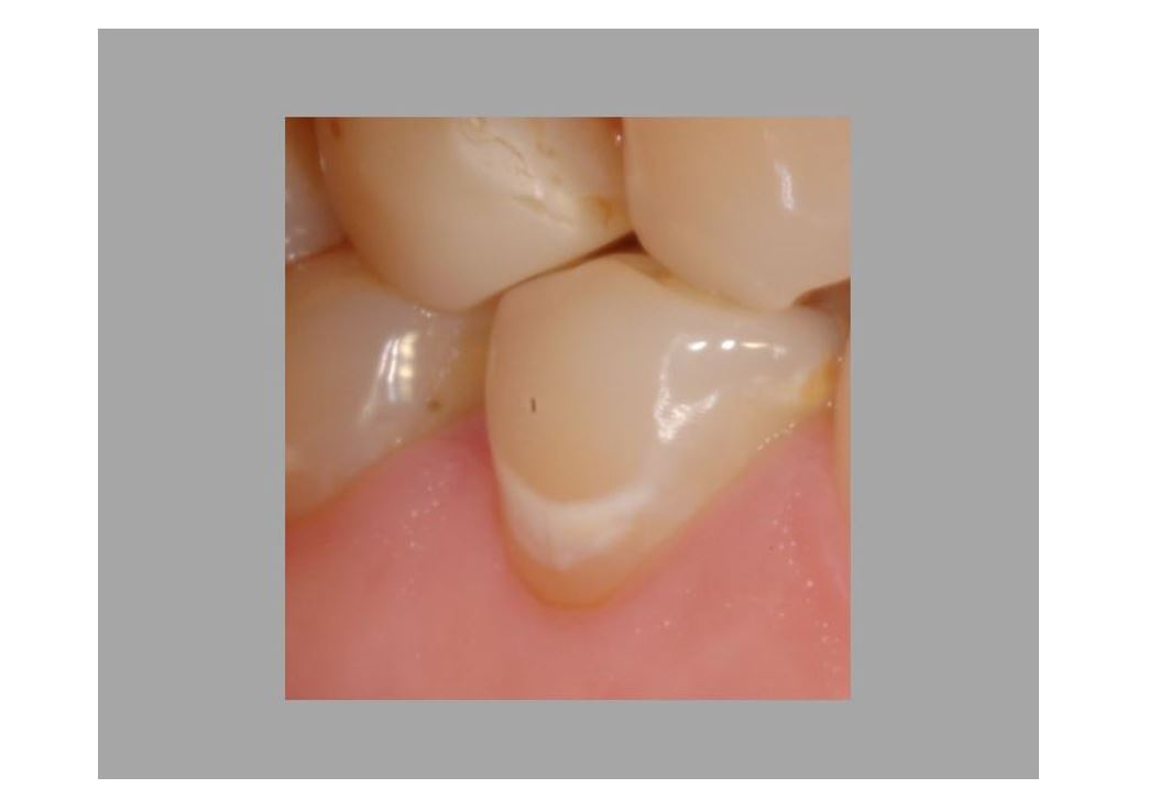 When to intervene in the caries process?