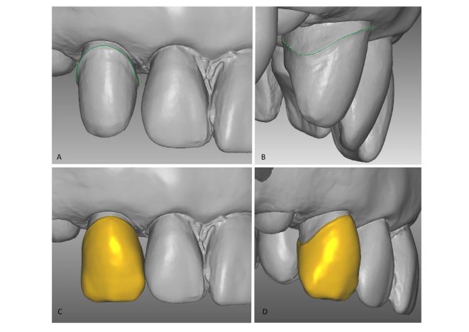 Improved bonding of zirconia crowns with resin-based cement