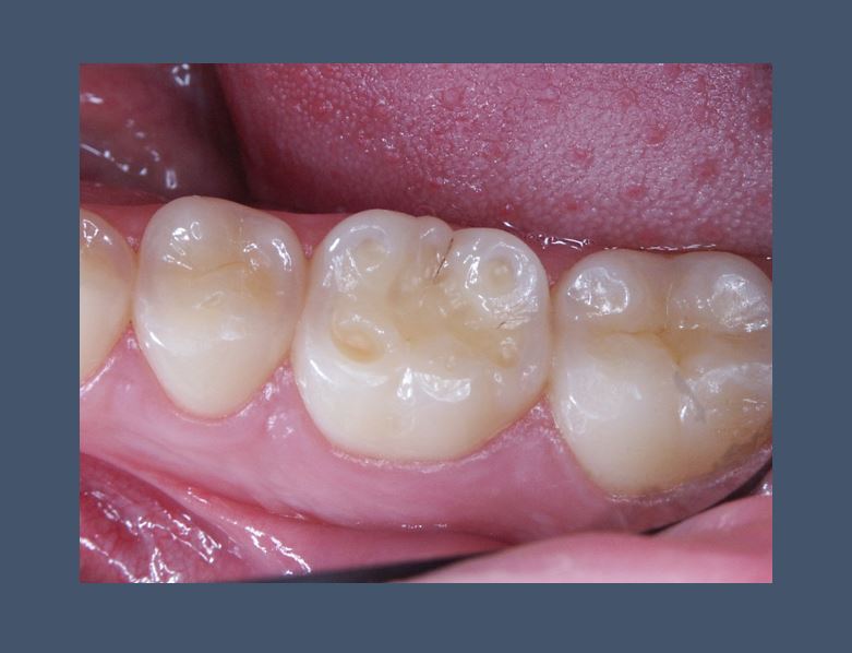 Saliva proteins may protect against erosive tooth wear