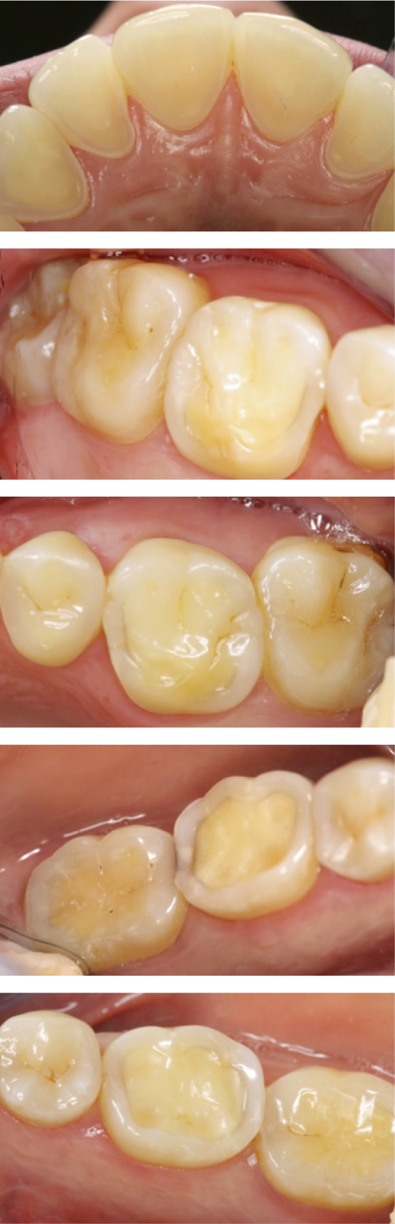 Opinions and Treatment decisions 
for Dental Erosion