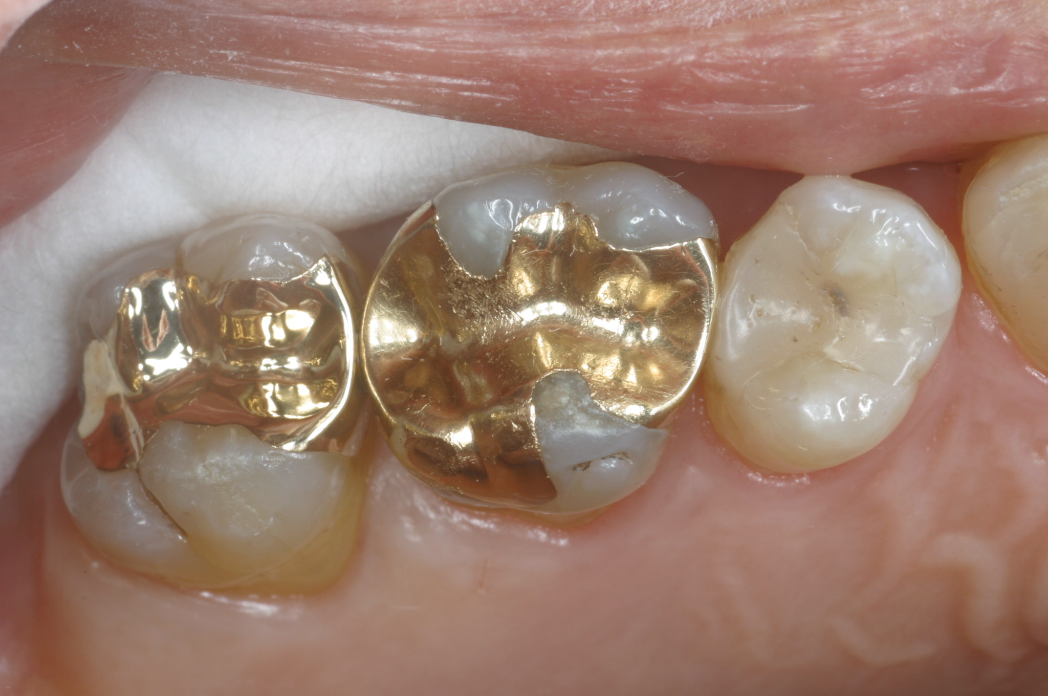 Gold inlays are a good treatment option for posterior teeth