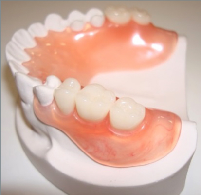 Nylon dentures may be a good alternative
