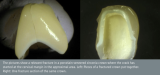 Testing of all-ceramic crowns  – from the laboratory bench to clinical relevance