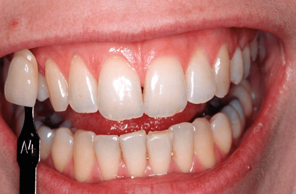 Discomfort and pain are common after tooth bleaching