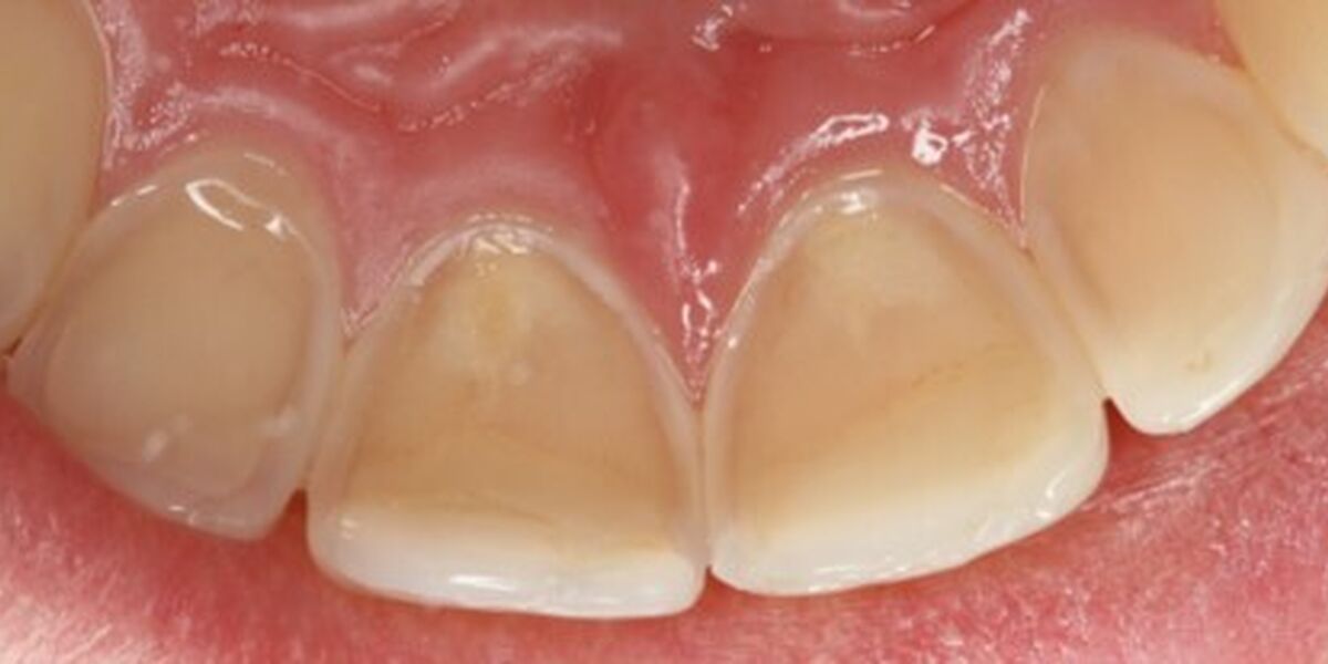 A photo of teeth with dental erosions
