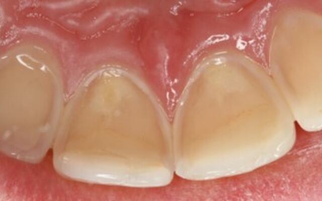 A photo of teeth with dental erosions